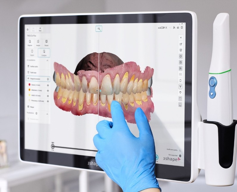 Intra-oral Scanner